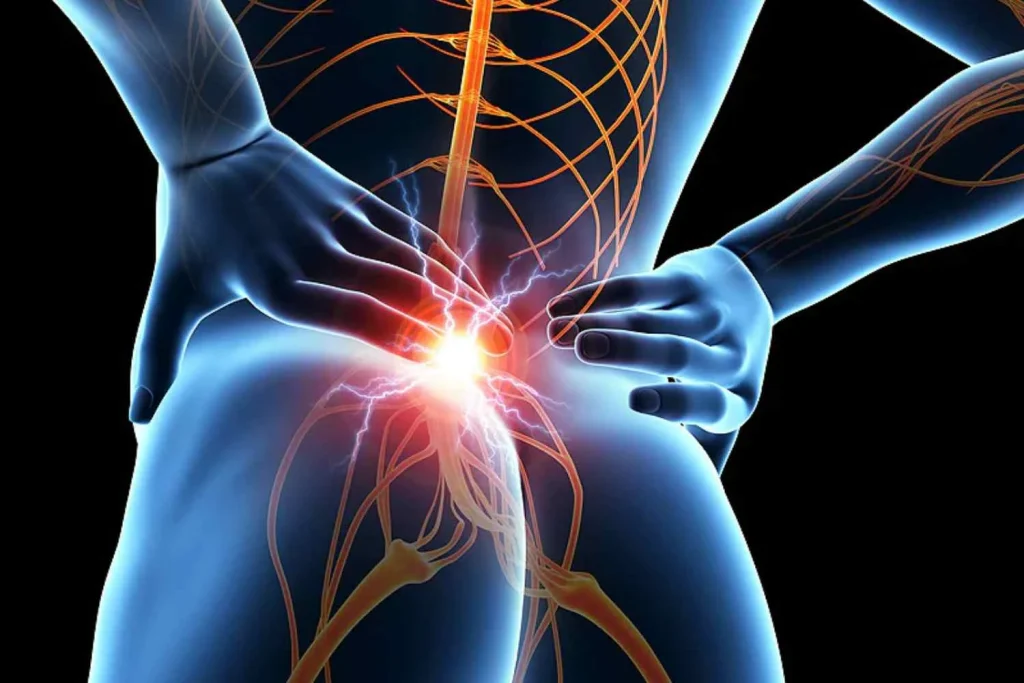 Sciatica overview