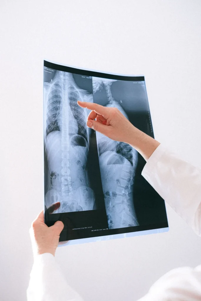 Scoliosis overview